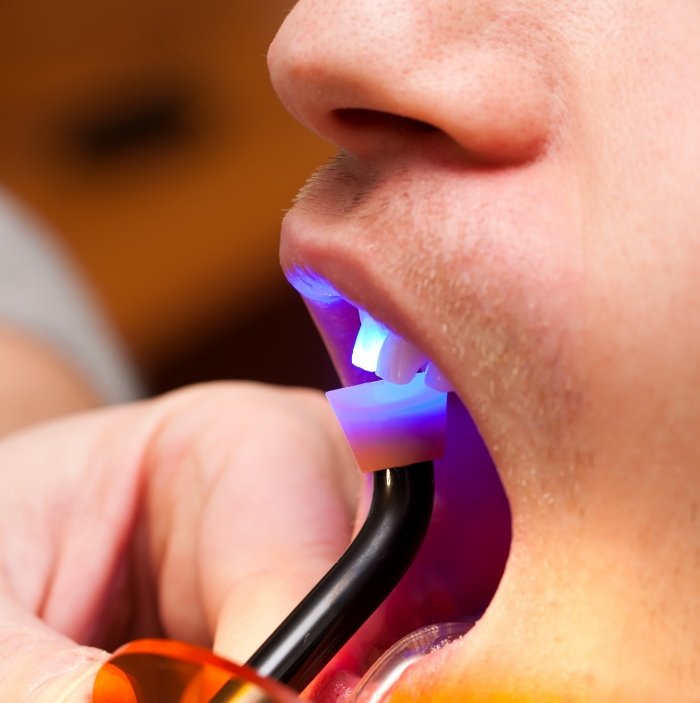 Close up of patient receiving cosmetic dental bonding on upper tooth