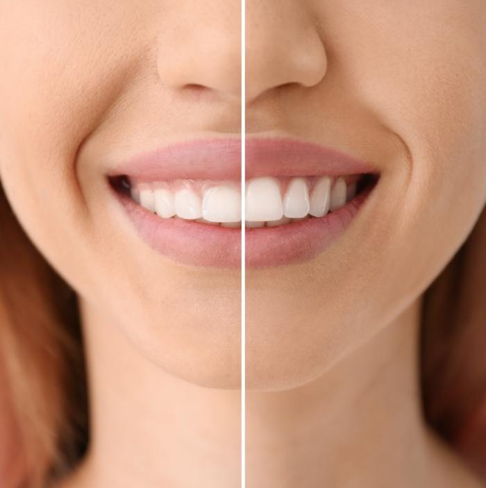 Close up of smile before and after gummy smile correction