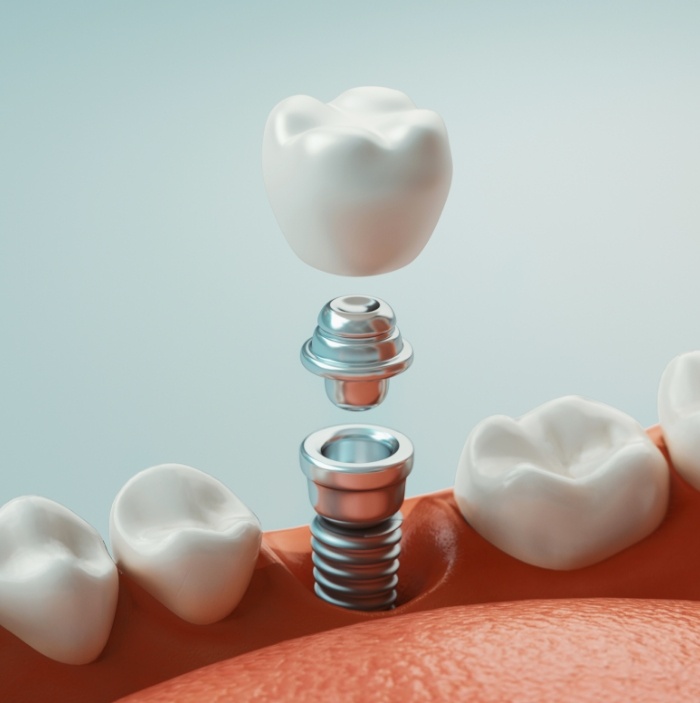 Illustrated dental implant replacing a missing lower tooth