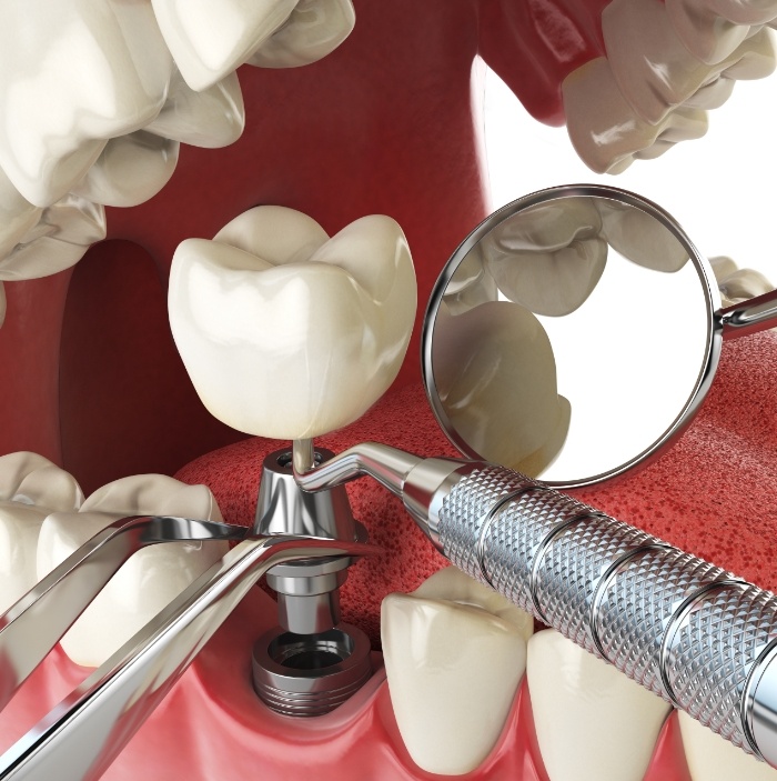 Illustrated dental implant being placed into the lower jaw