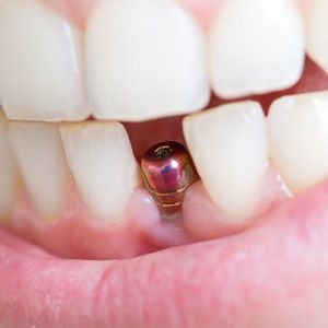 A closeup of a dental implant and its abutment