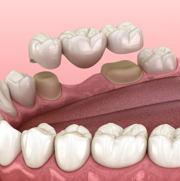 Illustrated dental bridge replacing a missing tooth