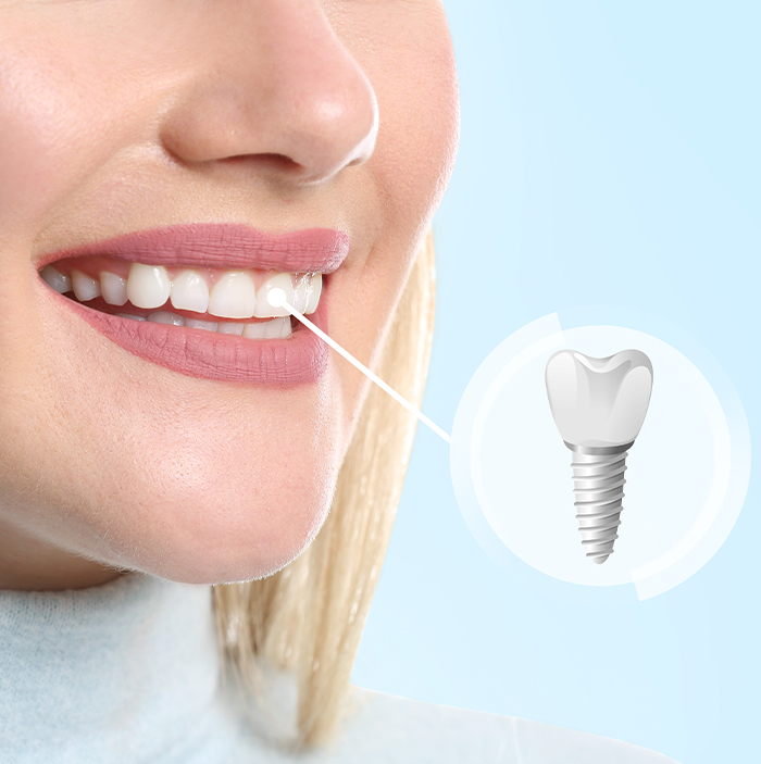 Close up of woman smiling with a dental implant