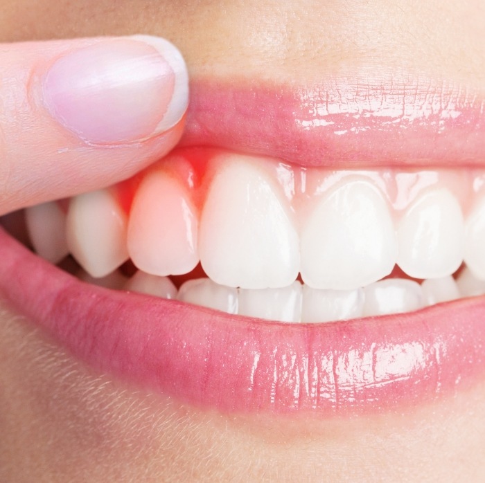 Close up of person pointing to red spot in their gums