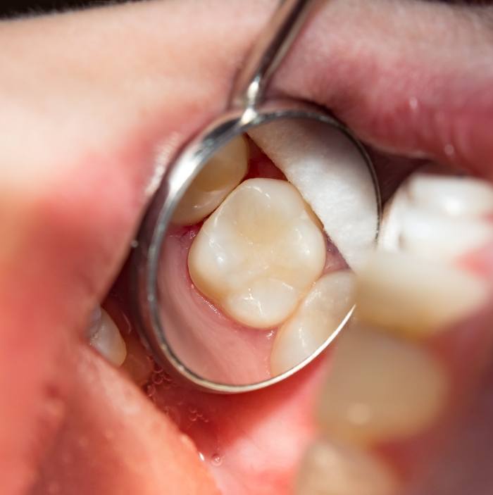 Close up of dental mirror in mouth reflecting natural looking tooth