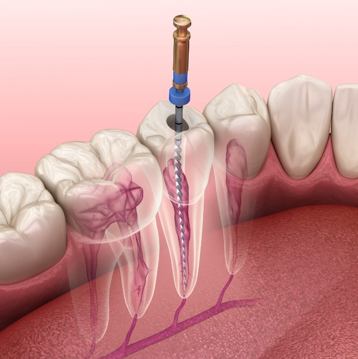 Illustrated dental instrument cleaning inside of a tooth during root canal treatment