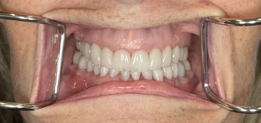 Mouth with brighter teeth