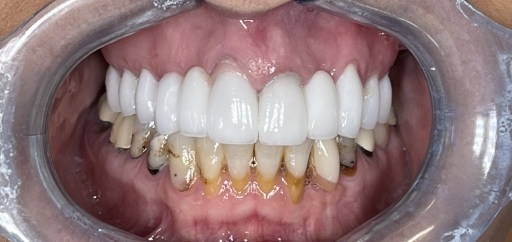 Close up of mouth with full row of white upper teeth