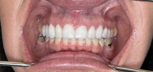 Mouth with whiter teeth