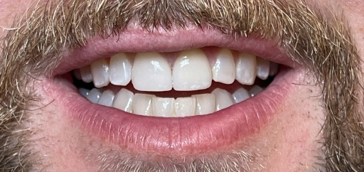 Close up of man smiling after fixing tooth with cosmetic dentistry in Scottsdale