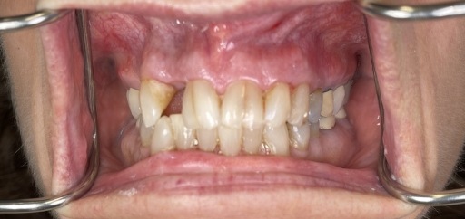Mouth with several damaged teeth and a missing tooth