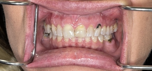 Mouth with discolored teeth