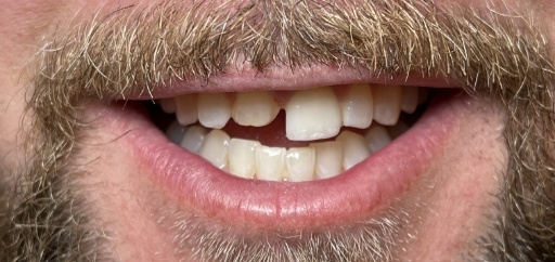 Close up of smiling man with short upper front tooth