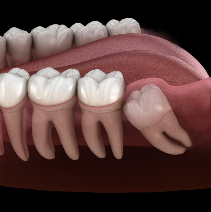 Illustrated impacted wisdom tooth pushing against back molar