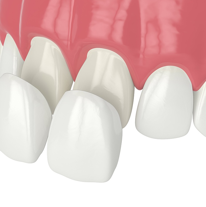 Illustration of veneers